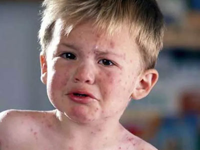 Điều cha mẹ nên biết để phòng thủy đậu cho bé trong mùa hè