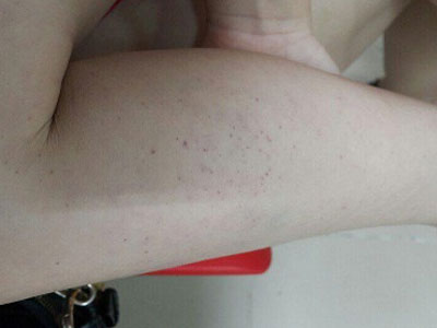 Cảnh báo căn bệnh nguy hiểm thường nhầm với sốt phát ban ở trẻ
