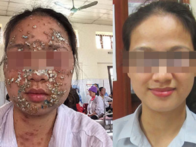 Người sưng phù, thay đổi cả hình dạng vì nhiễm giun sán