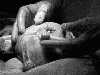Thai nhi thò tay từ tử cung mẹ - 17 năm trước và bây giờ