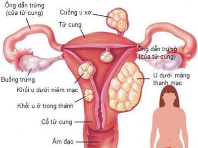 Nhiều phụ nữ bị u xơ tử cung mà không biết