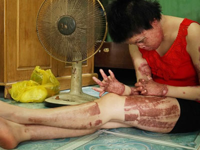 Người bị chồng tưới xăng đốt: Con thấy mặt tôi là khóc thét