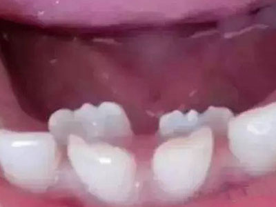 Bé 8 tuổi có tới 3 hàm răng vì mẹ liên tục cho ăn cháo thay cơm