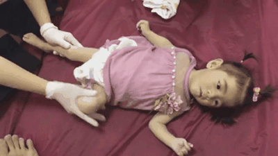 Bé gái Lào Cai 14 tháng tuổi chỉ nặng 3,5kg đang tập vật lý trị liệu và đã được 6,5kg