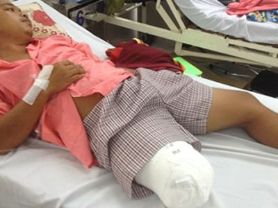 Cưa chân vì bác sĩ chẩn đoán "chấn thương phần mềm"