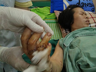 Rùng mình chồng chém vợ đứt lìa bàn tay
