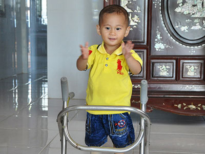 "Cậu bé văng khỏi bụng mẹ" bước vững vàng trên chân giả