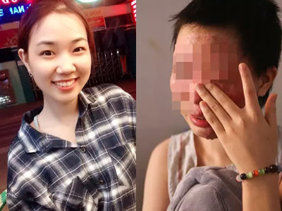 Nữ sinh từng bị tạt axit chấn động Sài Gòn: "Em vẫn không hiểu mình đã làm gì sai..."