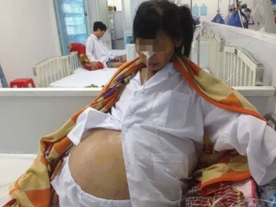 Mang khối u buồng trứng nặng 32kg vì không điều trị