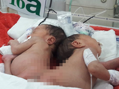 Hai bé sơ sinh dính nhau phần mông