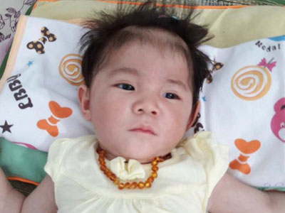 Thông tin mới nhất về em bé 14 tháng nặng 3,5kg ở Lào Cai