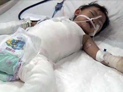 Mẹ đi vệ sinh, bé gái 2 tuổi bị cả nồi canh đang sôi đổ lên người