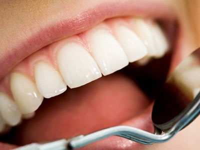 Thực hư việc lấy cao răng làm răng yếu đi