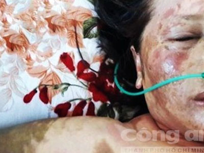 Thuê cháu tạt axit vào mặt người tình