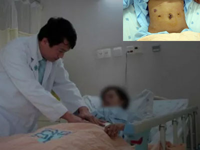23 tuổi ung thư giai đoạn muộn: Cảnh báo nguy cơ khi ăn đồ nướng