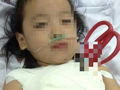 Bé gái 5 tuổi bị kéo cắt đâm xuyên ngực