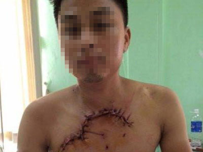 Hy hữu: Nam thanh niên ngã xe máy lòi tim phổi ra ngoài