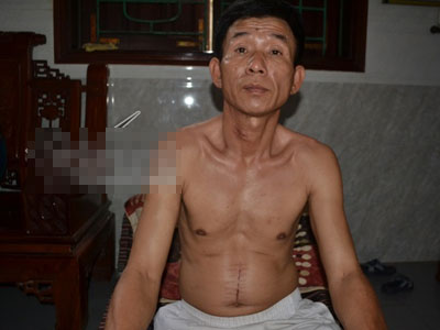 Bệnh nhân "phản pháo" GS hàng đầu mở bụng không cắt u