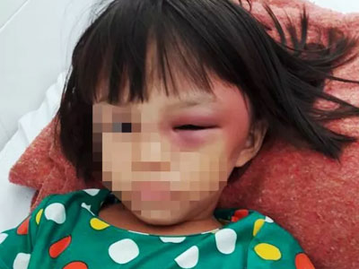 Nghi án bé gái 7 tuổi bị mẹ kế bạo hành