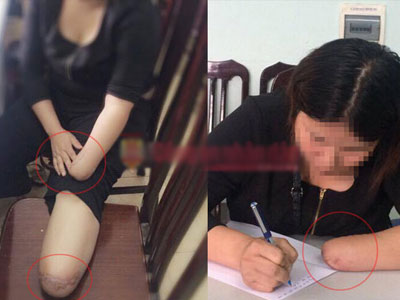 Hãi hùng lời thú nhận thuê chặt chân tay để trục lợi của cô gái trẻ