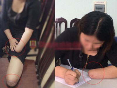 Thuê chặt chân tay để hưởng bảo hiểm 3 tỷ trong khi đang mang án tù do môi giới mại dâm