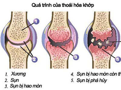 Thay khớp gối nhân tạo bằng xi măng cho bệnh nhân thoái hóa