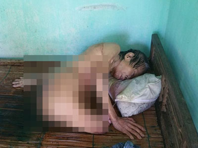 Cộng đồng kêu gọi giúp đỡ cụ bà mù, cụt chân đang thoi thóp vì vết thương lở loét