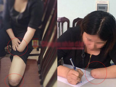 Vụ thuê chặt chân tay: Chỉ là 1 trong 8.000 vụ trục lợi bảo hiểm mỗi năm