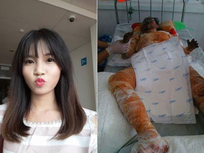 Bố của cô gái xinh đẹp bị bỏng nặng: “Con tôi bảo nó sợ cụt hết tay, thành dị dạng không ai dám đến gần”