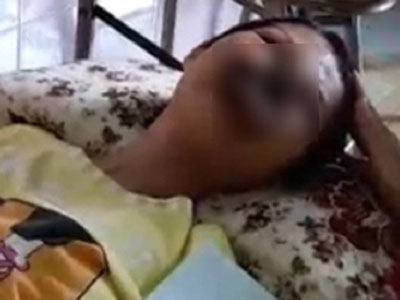 Cô gái ở Đồng Nai mắc bệnh lạ, khuôn mặt bị ăn mòn cả hàm trên và mũi