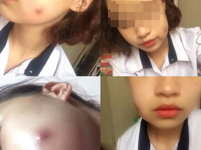 9X có nguy cơ thủng má vì đi spa làm lúm đồng tiền
