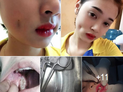 Cô gái trẻ xinh đẹp tố cơ sở thẩm mỹ giá rẻ làm má lúm đồng tiền hỏng khiến mặt bị biến dạng