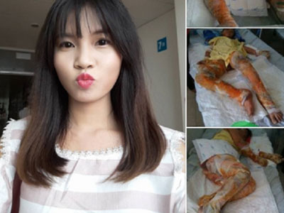 Cha hiến da ghép cho con gái bị bỏng nặng
