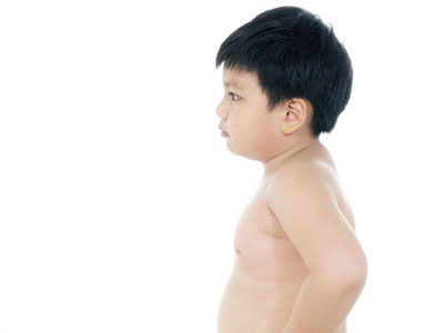 Trẻ 3 tuổi nặng gần 18 kg làm sao giảm cân