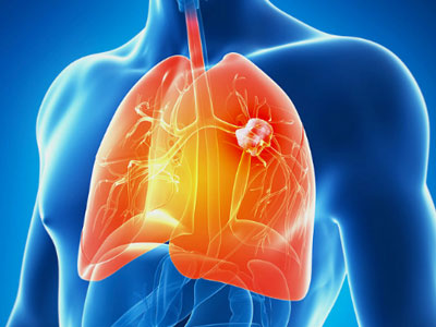 Ngừa ung thư phổi, detox chỉ 3 ngày