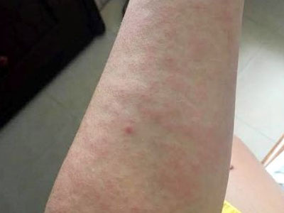 Cẩn trọng bệnh da do đi mưa và lội nước ngập