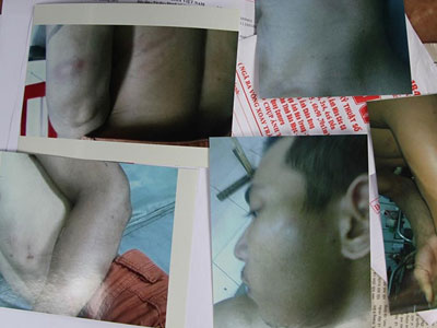 Dân tố bị Trưởng Công an xã đánh trọng thương vì dắt xe vô chủ