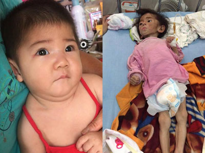 Hình ảnh mới của bé gái 14 tháng tuổi nặng 3,5kg sau hơn 3 tháng được mẹ nuôi chăm sóc