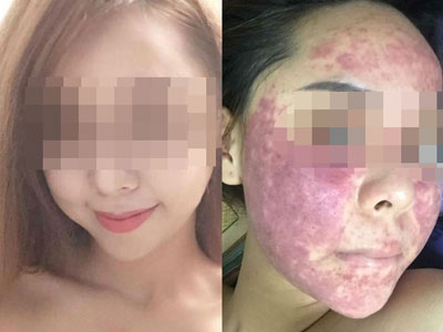 Cô gái chịu hậu quả nặng nề sau khi dùng kem thảo dược