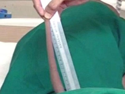 "Cậu bé thần khỉ" được cắt đuôi dài 18cm vì không ngồi được