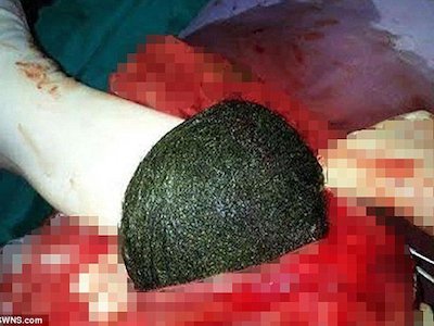 Đau bụng, đi viện khám thấy mớ tóc khổng lồ to bằng quả dưa