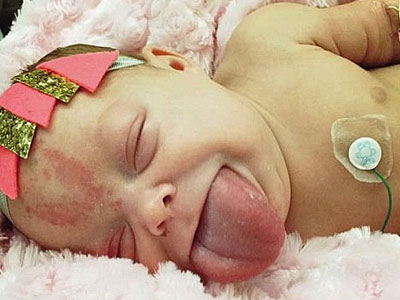 Bé gái chào đời với chiếc lưỡi khổng lồ to gấp đôi của người lớn