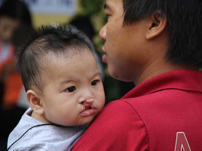 Phẫu thuật miễn phí cho 500 trẻ em bị hở môi hàm ếch