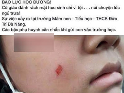 Đình chỉ 1 tháng, phạt 5 triệu cô giáo làm trầy má HS tại Đà Nẵng
