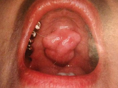 U lồi xương răng khiến nhiều người lo sợ bị ung thư