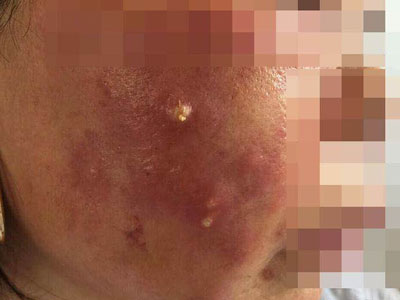Mẹ và con gái ruột nhập viện sau tiêm thuốc làm trắng da