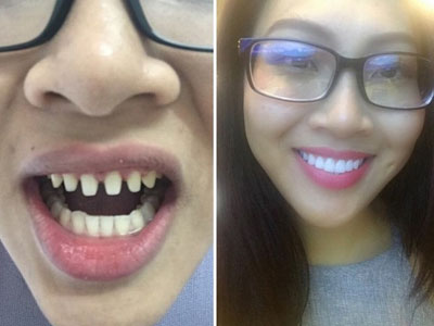 Hoa khôi Diệu Ngọc - Đại diện người đẹp Việt ở Hoa hậu Thế giới bị tố phẫu thuật thẩm mỹ