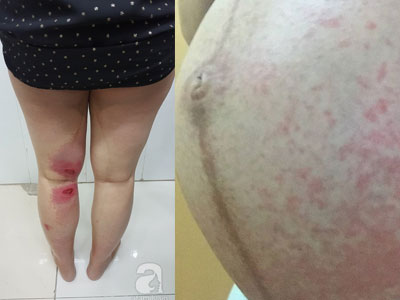 Một sản phụ chân bỏng rát, nổi nhiều bóng nước, bụng nổi ban do nghi bị kiến ba khoang cắn
