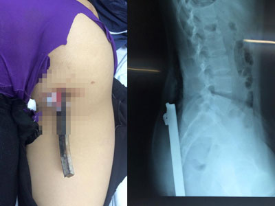 Nữ sinh bị thanh sắt trên xe ba bánh đâm xuyên người