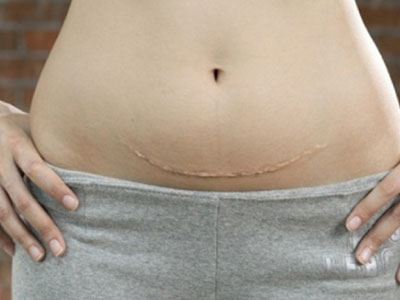 3 sự thật về sinh mổ có thể mẹ bầu chưa biết